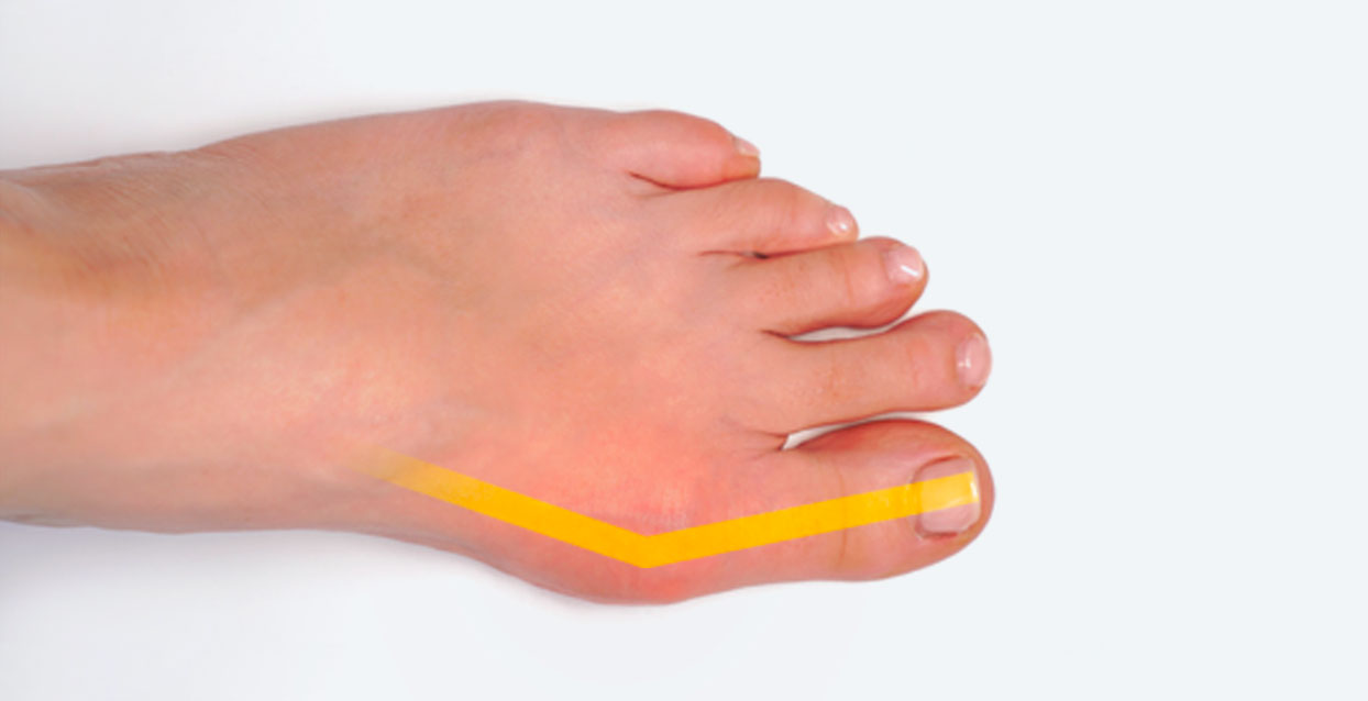 Image showing a mild bunion on the side of the big toe