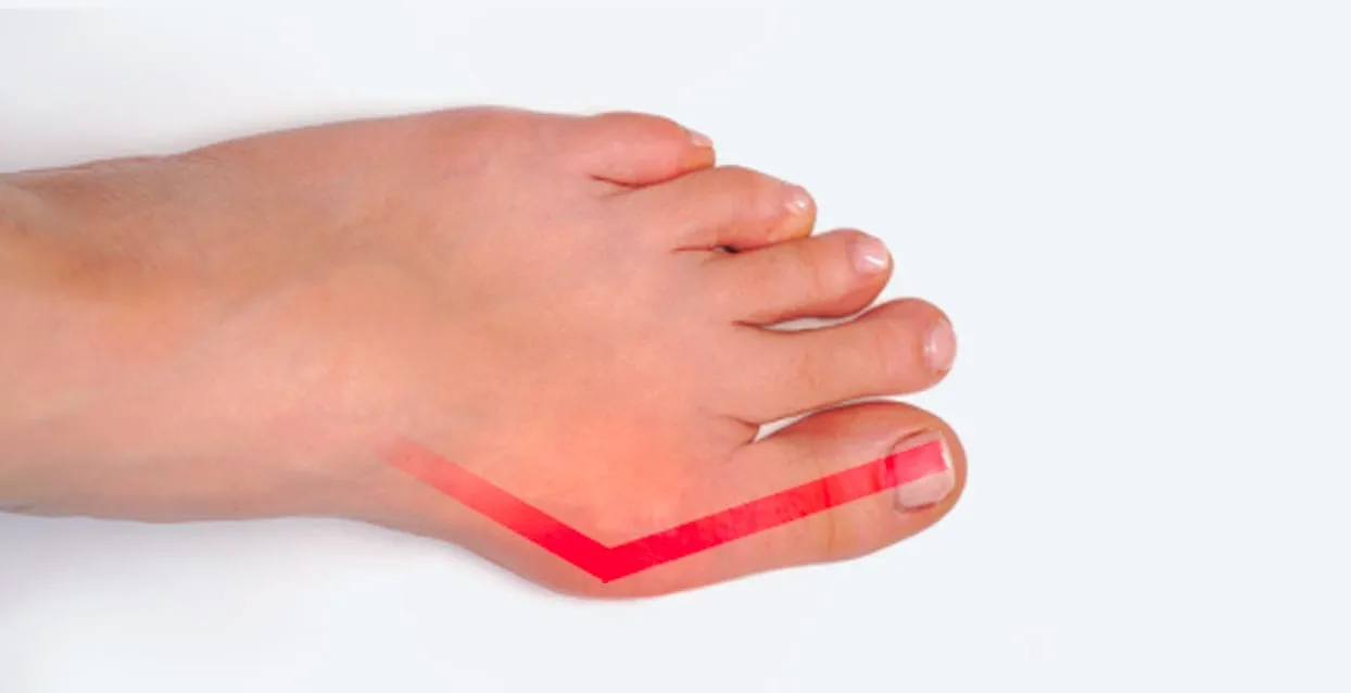 Image showing a moderate bunion on the side of the big toe