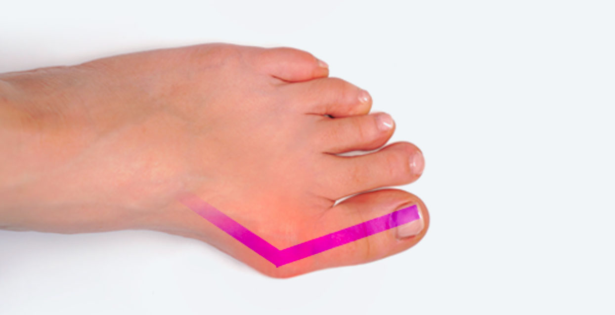 Image showing a moderate bunion on the side of the big toe